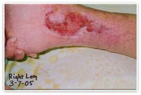Venous stasis ulcer