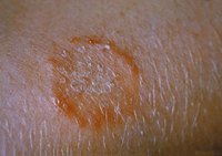 What Does Ringworm Look Like?