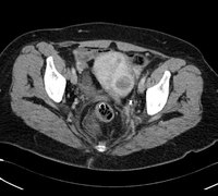 What Causes Fibroids?
