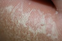 Callused skin