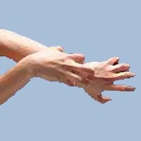 Eczema