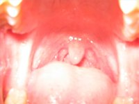 Uvula Infection