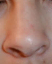 Nose Bleeds in Adults