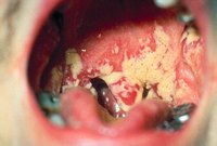 Body Fungus Symptoms