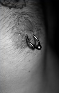 Nipple Piercing Infection