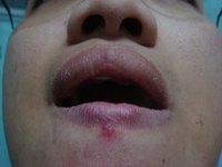 Contagious Stages of Herpes