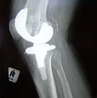 Allergic Reaction to Knee Replacement