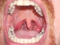 Throat Infection Bacterias