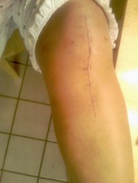 Problem With Artificial Knees