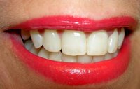 You can whiten your teeth at home in two weeks.