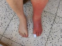 Test for Cellulitis