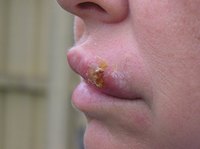 What Can I Put on a Peeling Cold Sore?