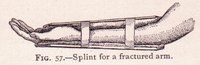 A well-crafted homemade splint stabilizes a broken bone.