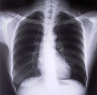 Lung Diseases & Disorders