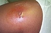 Get Rid of a Boil With a Bottle