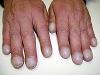 Clubbed Fingers and Heart Disease