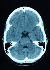 Brain Cyst Treatments