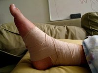 How Long Does a Sprained Ankle Take to Heal?