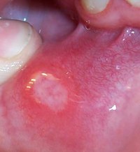 Herpes Stomatitis in Adults