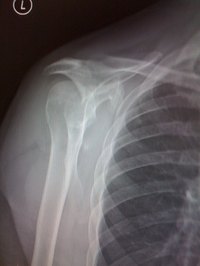 Treat Tendonitis Pain in The Shoulder