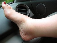 Edema is most typically a swelling in the feet.