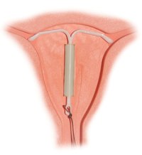 Problems With Mirena IUD