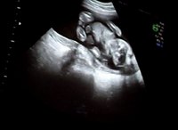 An Rh negative woman pregnant with a baby that has Rh positive blood can experience dangerous Rh incompatibility.