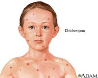 First Stages of Chicken Pox