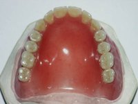 Alternatives to Tooth Implants