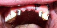 Tooth Implant Vs. Bridge