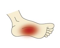 Plantar Fasciitis Shoes to Avoid
