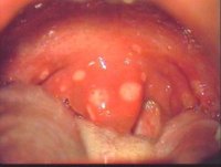 Throat Ulcer Symptoms