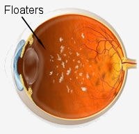 What Causes Floaters in the Eye?