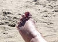 Information for Severely Swollen Legs & Feet