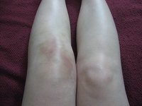 What Causes Fluid on the Knee?