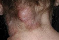 Signs of a Back Tumor