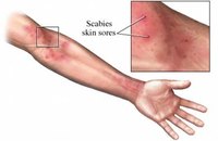 Identify scabies