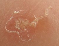 What Do Scabies Look Like on Human Skin?
