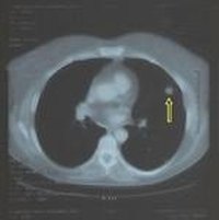 Characteristics of Benign Lung Nodules