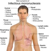 Glandular Fever in Adults