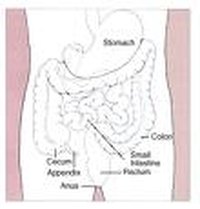 Prognosis of Stage 4 Colon Cancer