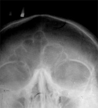 An x-ray showing the sinus cavities