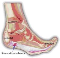Cure Plantar Fasciitis Fast