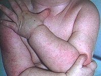 cure eczema