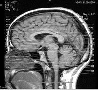 Reduce Dementia Naturally