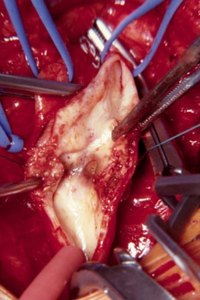 Remove Plaque In Arteries