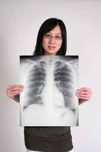 A chest X-ray can show a cardiac shadow.