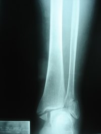 A broken ankle could require screws and plates to repair.