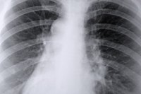 Asbestos inhalation due to exposure to old blown insulation causes lung disease and cancer.