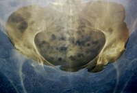 Bone marrow adema mostly affects the hip bones.